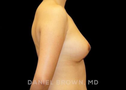 Breast Lift Before & After Patient #9502