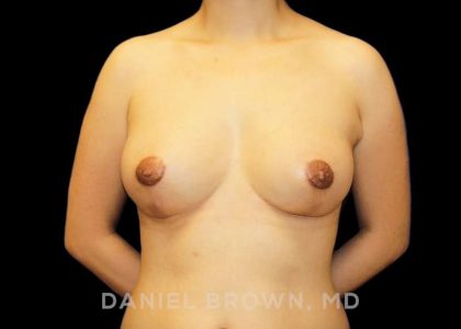 Breast Lift Before & After Patient #9502