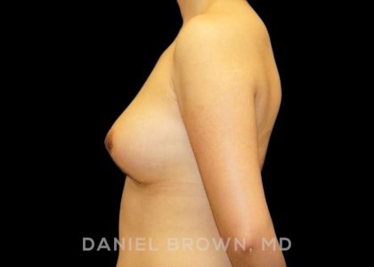 Breast Lift Before & After Patient #9502