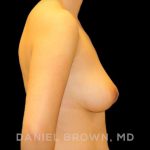 Breast Lift Before & After Patient #9502