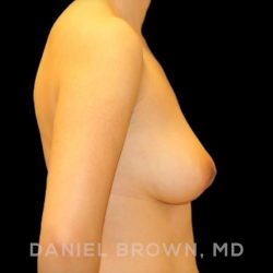 Breast Lift Before & After Patient #9502