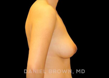 Breast Lift Before & After Patient #9502
