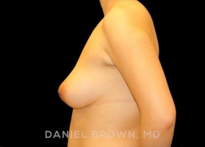 Breast Lift Before & After Patient #9502