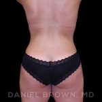 Buttock Enhancement Before & After Patient #9814