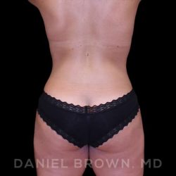 Buttock Enhancement Before & After Patient #9814