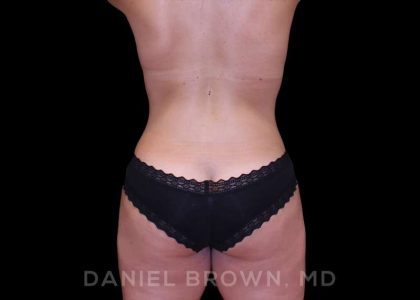 Buttock Enhancement Before & After Patient #9814