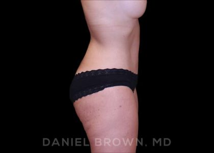 Buttock Enhancement Before & After Patient #9814