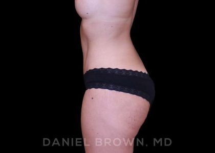 Buttock Enhancement Before & After Patient #9814