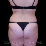 Buttock Enhancement Before & After Patient #9814