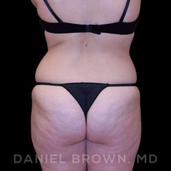 Buttock Enhancement Before & After Patient #9814