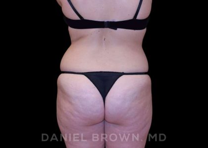 Buttock Enhancement Before & After Patient #9814