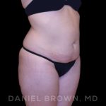 Buttock Enhancement Before & After Patient #9814