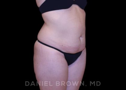 Buttock Enhancement Before & After Patient #9814
