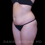 Buttock Enhancement Before & After Patient #9814