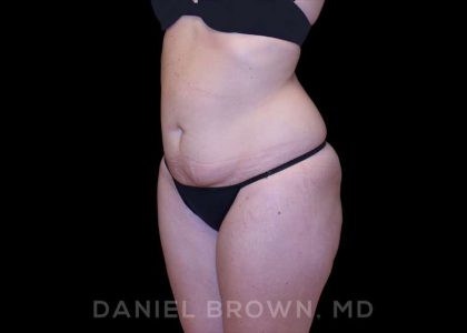 Buttock Enhancement Before & After Patient #9814