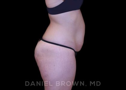 Buttock Enhancement Before & After Patient #9814