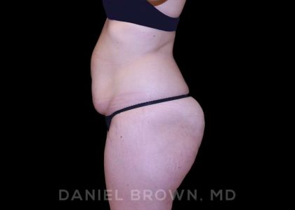 Buttock Enhancement Before & After Patient #9814