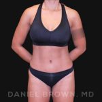 Tummy Tuck Before & After Patient #10678