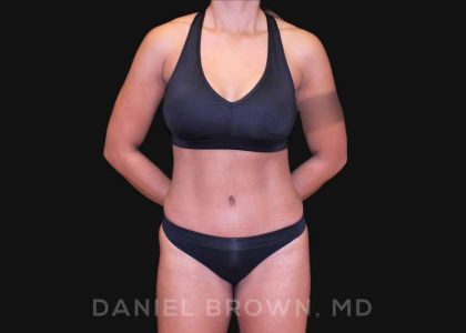 Tummy Tuck Before & After Patient #10678