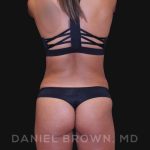 Tummy Tuck Before & After Patient #10678