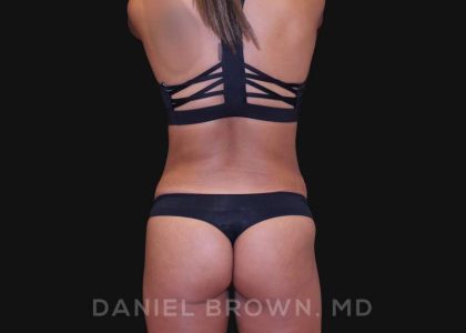 Tummy Tuck Before & After Patient #10678