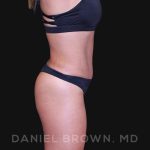 Tummy Tuck Before & After Patient #10678
