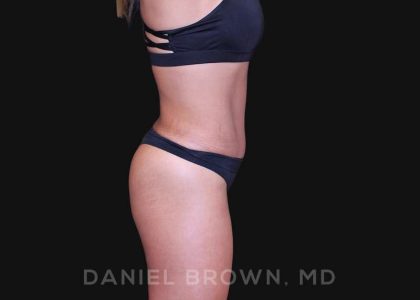 Tummy Tuck Before & After Patient #10678
