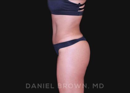 Tummy Tuck Before & After Patient #10678