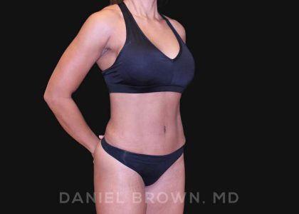 Tummy Tuck Before & After Patient #10678