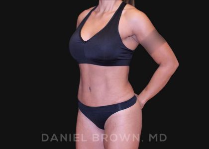 Tummy Tuck Before & After Patient #10678