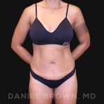 Tummy Tuck Before & After Patient #10678