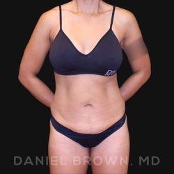 Tummy Tuck Before & After Patient #10678