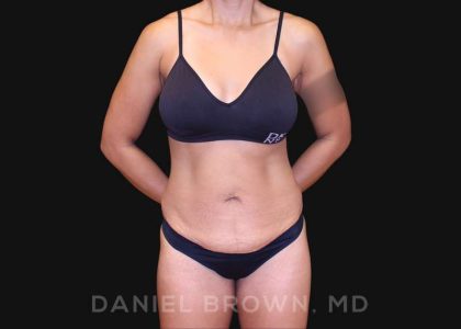 Tummy Tuck Before & After Patient #10678