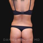 Tummy Tuck Before & After Patient #10678
