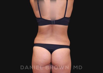 Tummy Tuck Before & After Patient #10678