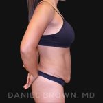 Tummy Tuck Before & After Patient #10678