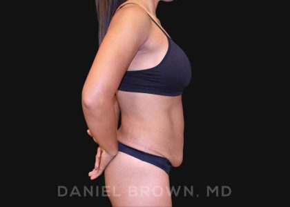 Tummy Tuck Before & After Patient #10678
