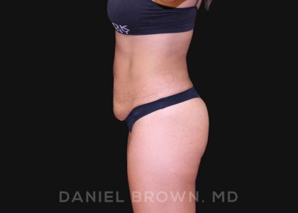 Tummy Tuck Before & After Patient #10678