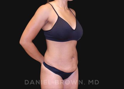 Tummy Tuck Before & After Patient #10678