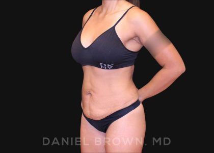 Tummy Tuck Before & After Patient #10678