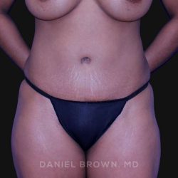 Tummy Tuck Before & After Patient #10689