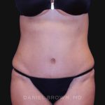 Tummy Tuck Before & After Patient #10702