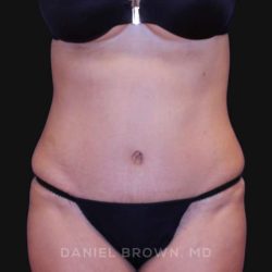 Tummy Tuck Before & After Patient #10702