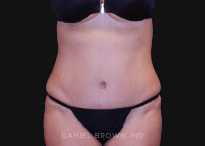 Tummy Tuck Before & After Patient #10702