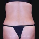Tummy Tuck Before & After Patient #10702