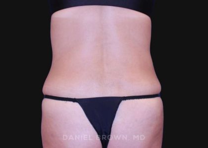Tummy Tuck Before & After Patient #10702