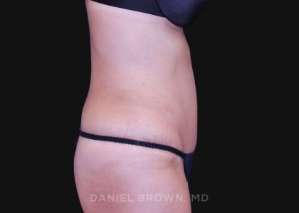 Tummy Tuck Before & After Patient #10702