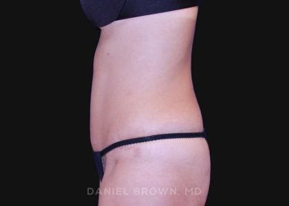Tummy Tuck Before & After Patient #10702