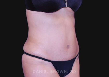 Tummy Tuck Before & After Patient #10702
