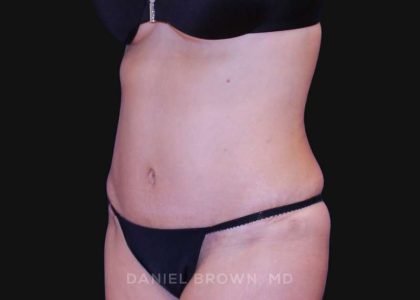 Tummy Tuck Before & After Patient #10702